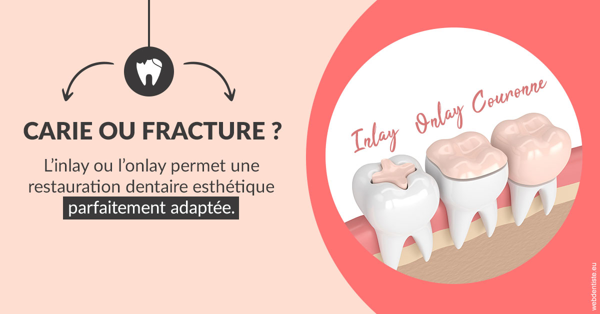 https://dr-ambert-tosi-laurence.chirurgiens-dentistes.fr/T2 2023 - Carie ou fracture 2