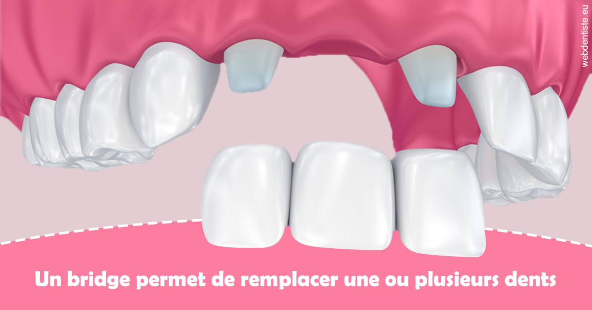 https://dr-ambert-tosi-laurence.chirurgiens-dentistes.fr/Bridge remplacer dents 2