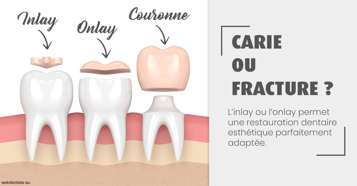 https://dr-ambert-tosi-laurence.chirurgiens-dentistes.fr/T2 2023 - Carie ou fracture 1