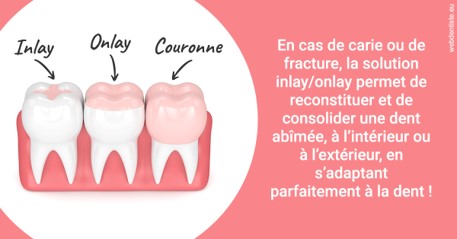 https://dr-ambert-tosi-laurence.chirurgiens-dentistes.fr/L'INLAY ou l'ONLAY 2