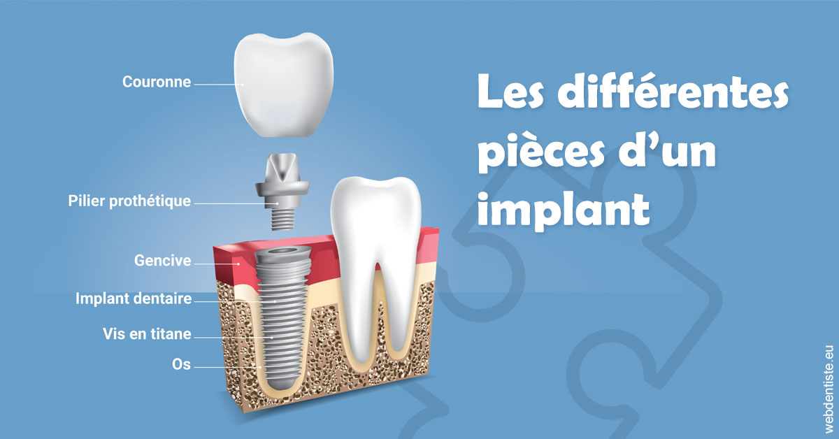 https://dr-ambert-tosi-laurence.chirurgiens-dentistes.fr/Les différentes pièces d’un implant 1